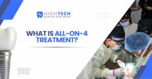 What Is All-on-4 Implant Treatment