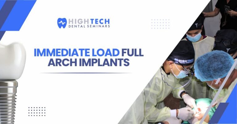 Immediate Load Full Arch Implants