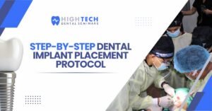 Step-by-Step Dental Implant Placement Protocol